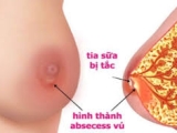 thông tắc tia sữa
