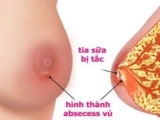 thông tắc tia sữa